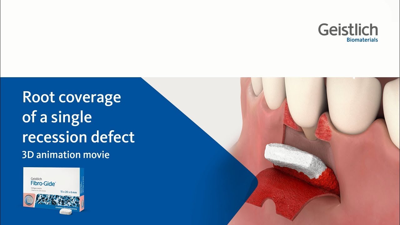 Geistlich Fibro-Gide&reg; - Root Coverage