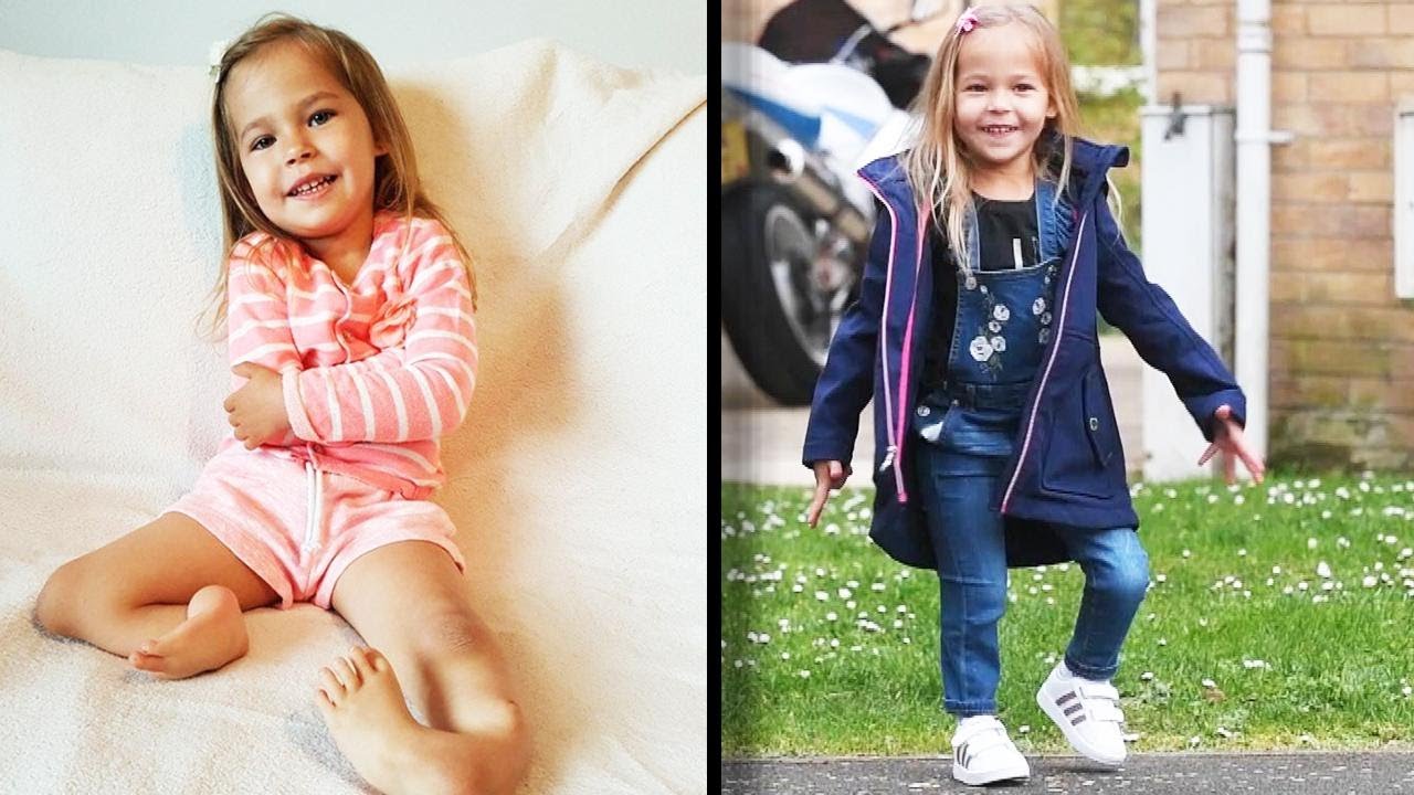 3-Year-Old Girl Born With Legs Bent Backward Is Now Walking