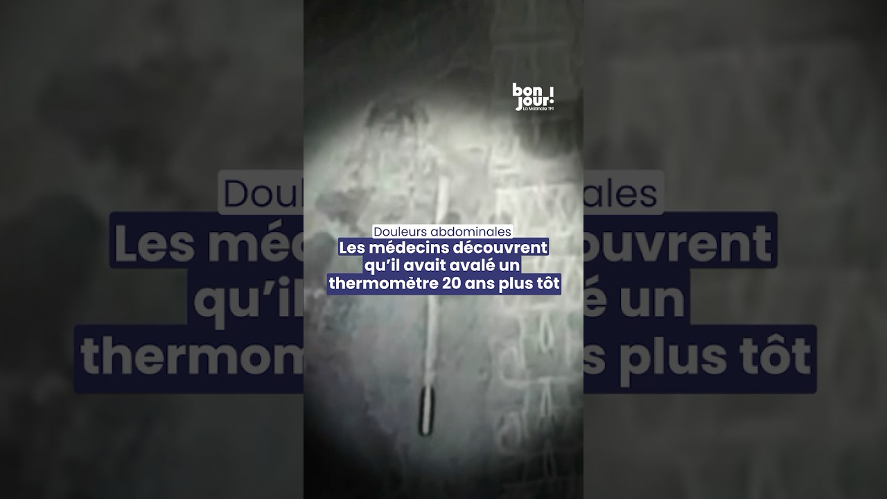 Douleurs abdominales : les m&eacute;decins d&eacute;couvrent qu'il avait aval&eacute; un thermom&egrave;tre 20 ans plus t&ocirc;t