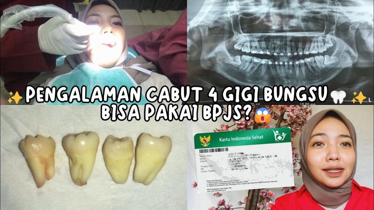 PENGALAMAN OPERASI GIGI BUNGSU🦷🥲 | BISA MENGGUNAKAN BPJS? PROSES DAN BIAYA TAHUN 2023 | Vlog #29