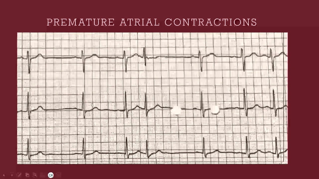Don't Miss a Beat: A Review of Palpitations & Tachycardia - Emily Brock Holt, FNP