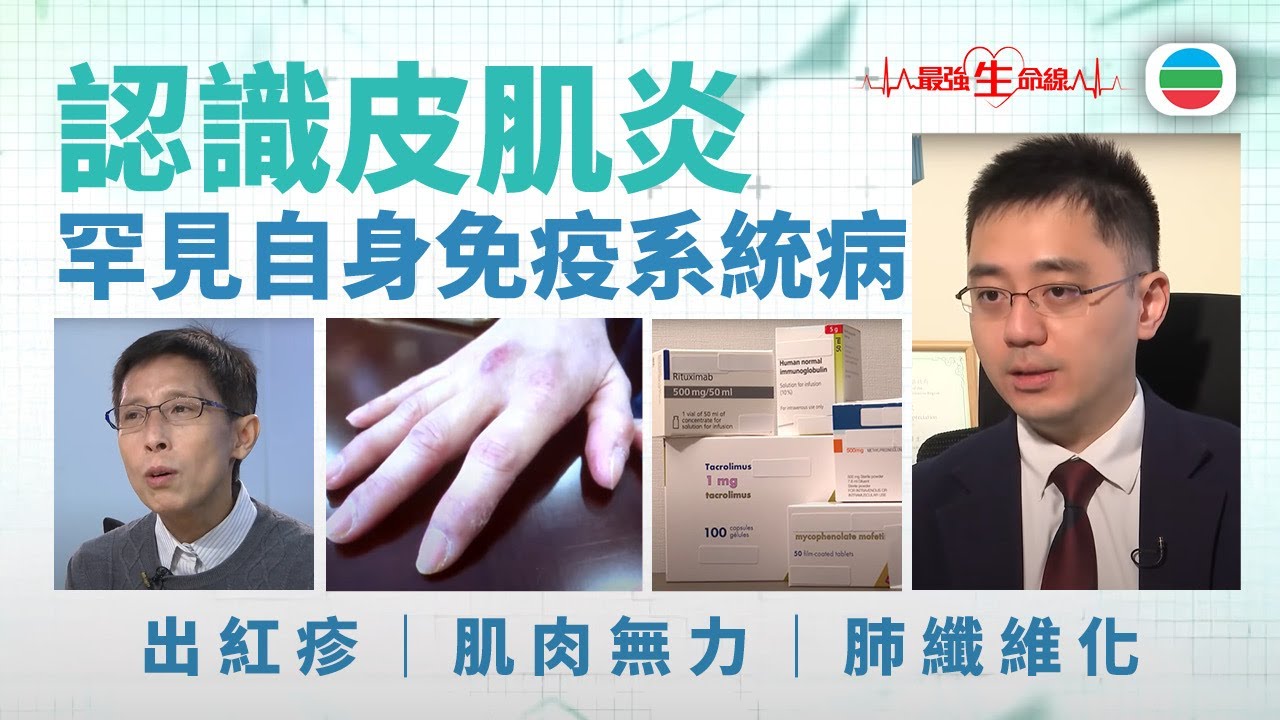 最強生命線｜皮肌炎成因未明　壓力、病毒感染、遺傳可增病發風險　把握診斷治療時機至關鍵 (繁 / 簡字幕)｜醫療｜治療｜無綫新聞 TVB News