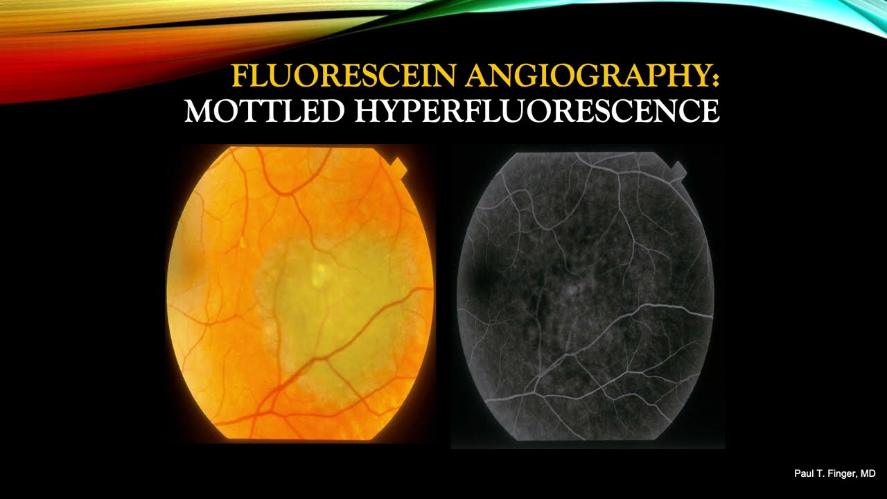 Photography and Angiography Part 2: Choroidal Nevus, Melanoma and Hemorrhage