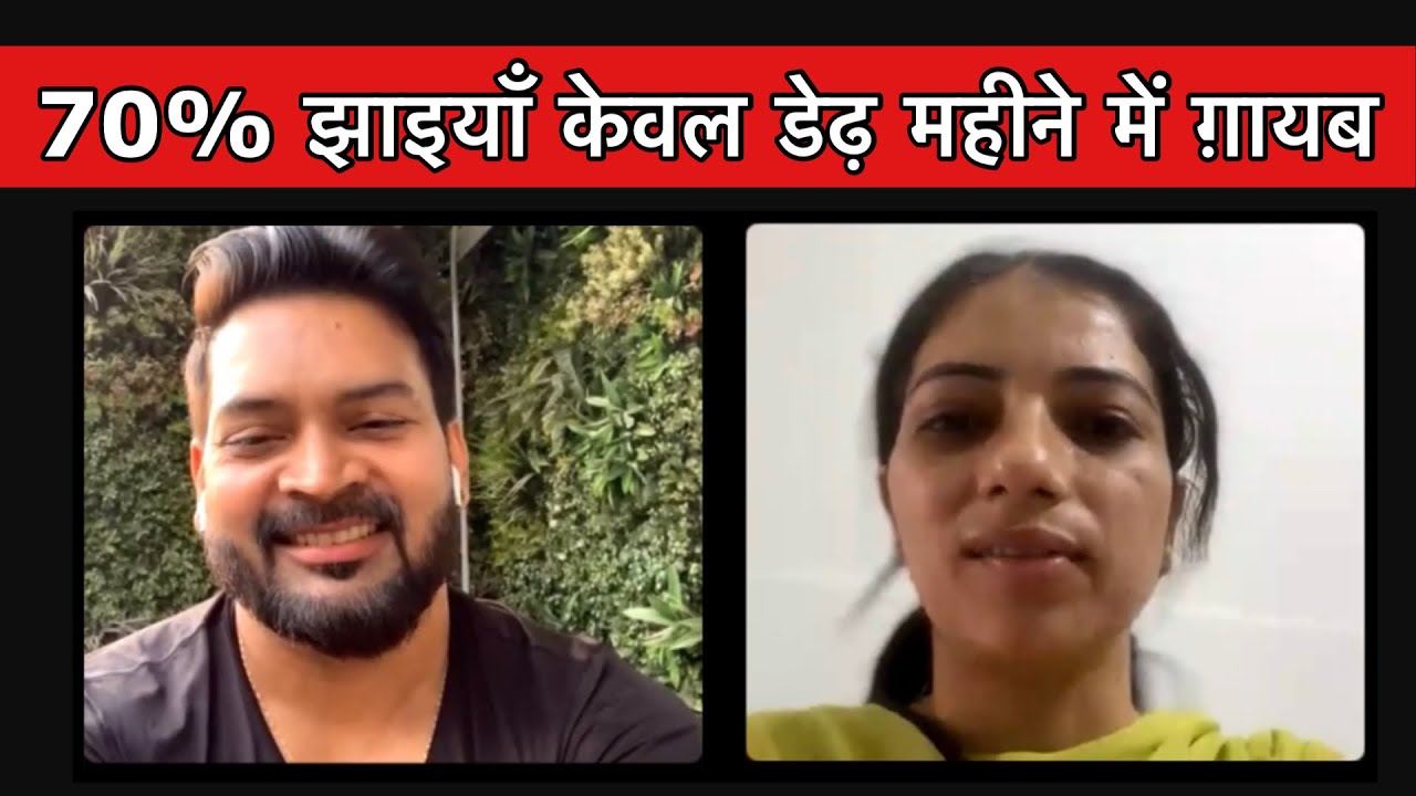 70% Melasma gone in a month. 70% झाइयाँ केवल डेढ़ महीने में ग़ायब