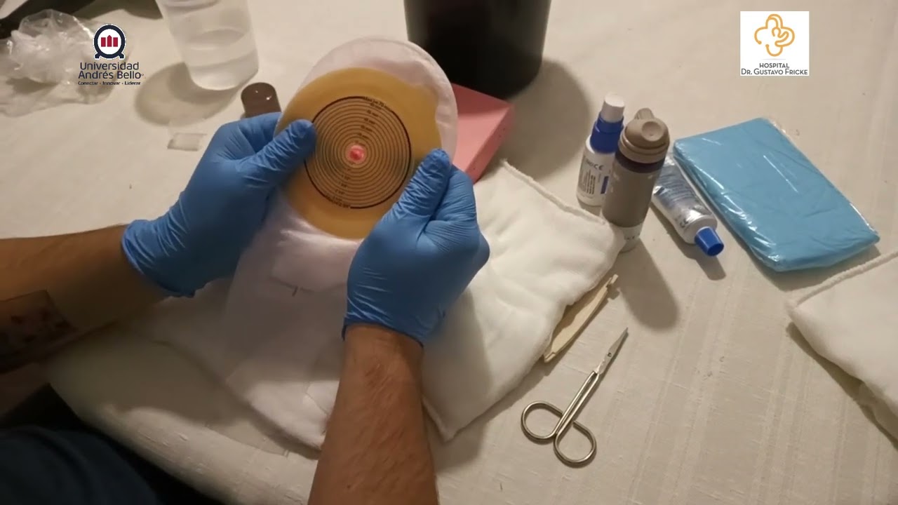 CAPSULA TECNICA: CAMBIO DE DISPOSITIVO DE OSTOMIA