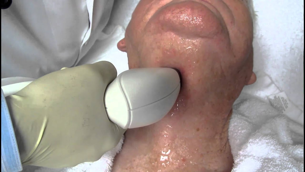 Facial Skin Tightening using Viora Reaction RF CORE