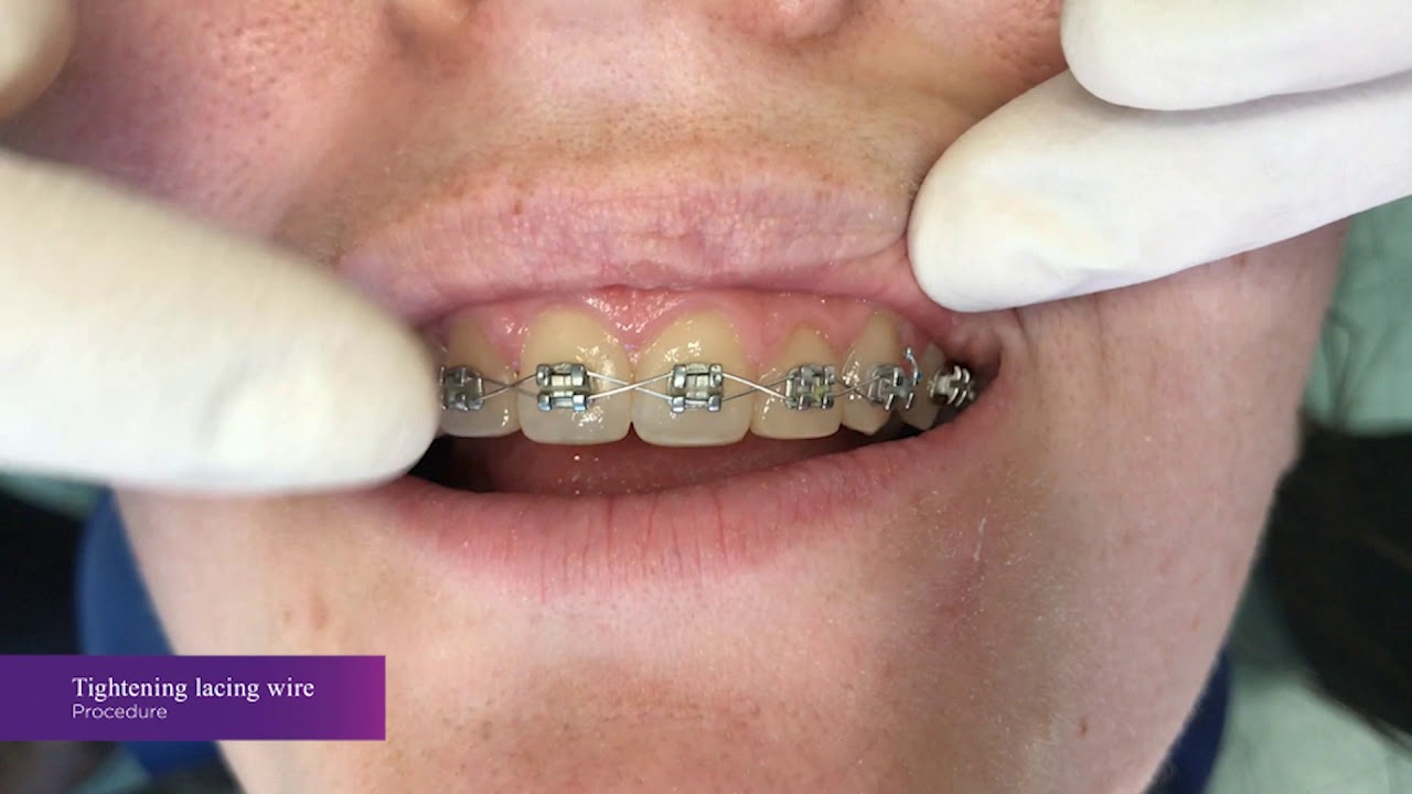 Orthodontic lacing