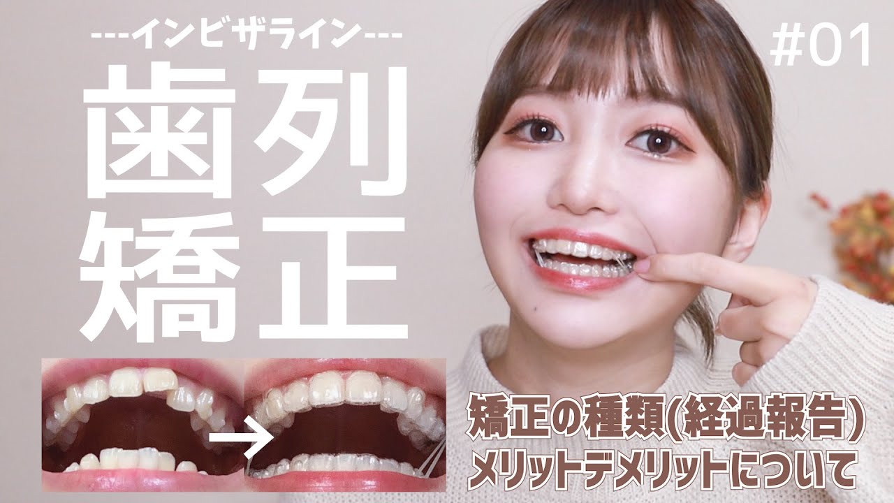 【歯列矯正】痛い？大変？歯列矯正を始めて感じたメリットデメリットを話します。【#1/インビザライン】