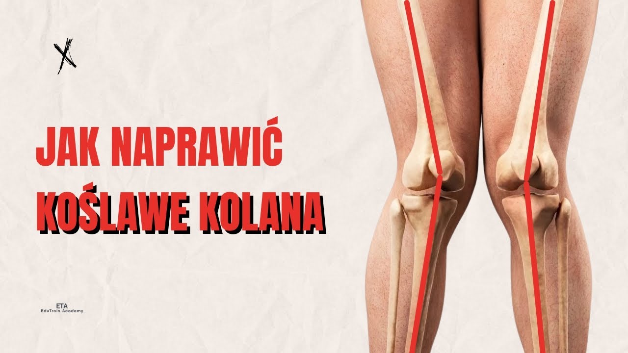 Jak naprawić koślawe kolana?