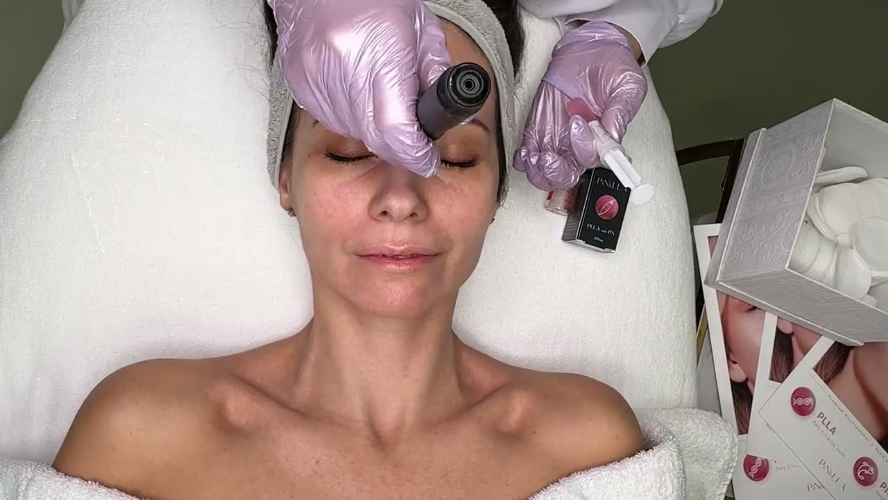 PiNkLLA protocol + dermapen