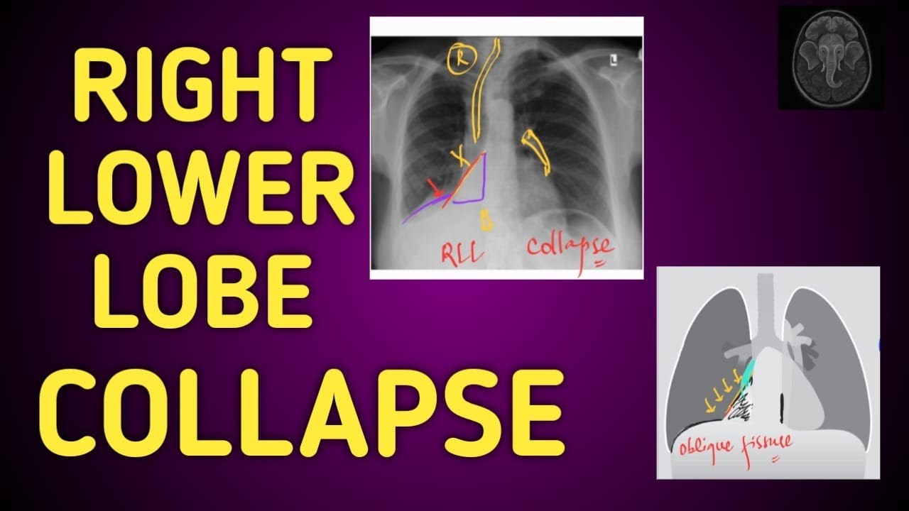Describing RIGHT LOWER LOBE Collapse on chest xray!