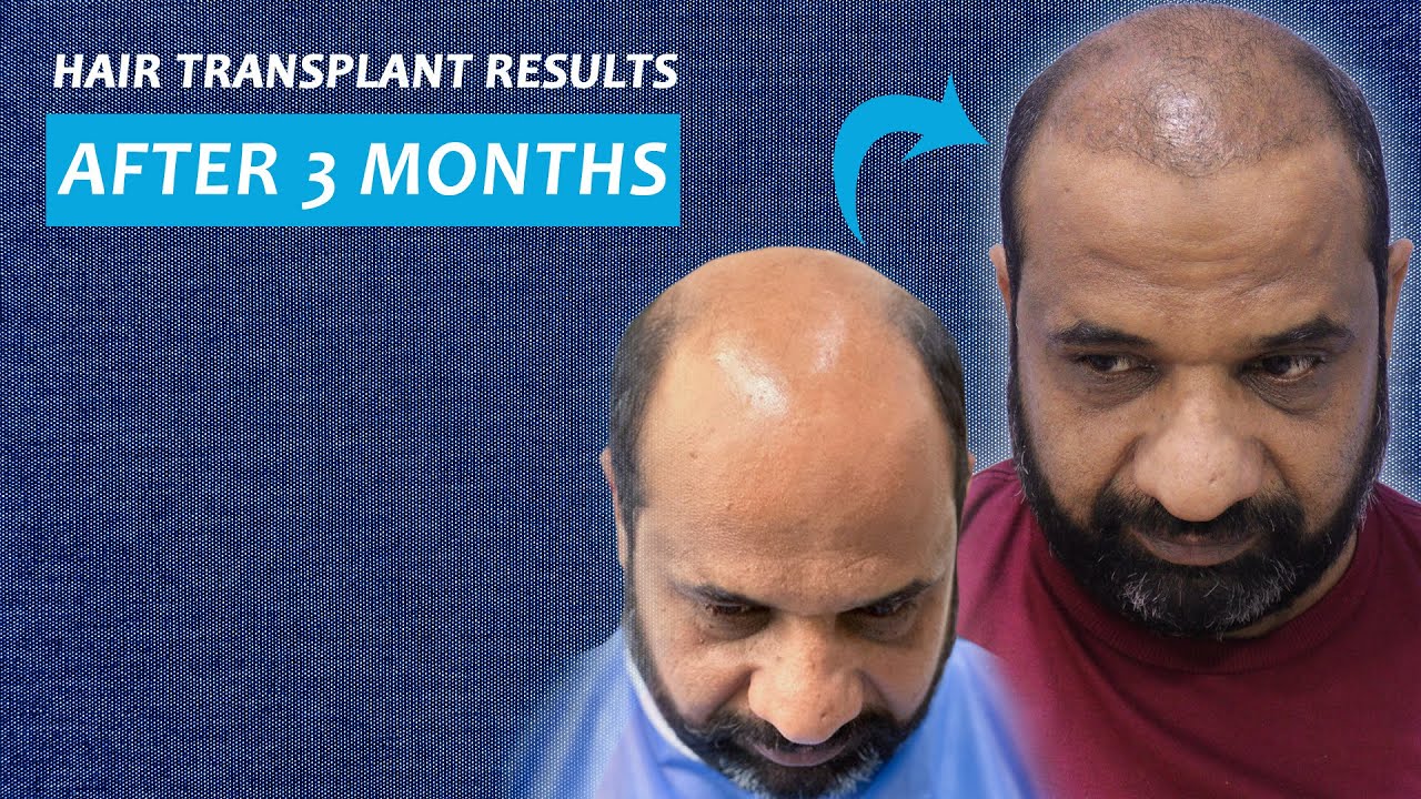 Hair Transplant Results After 3 Months | Demonstration by Dr. Jawad Jahangir | Jj Aesthetics.