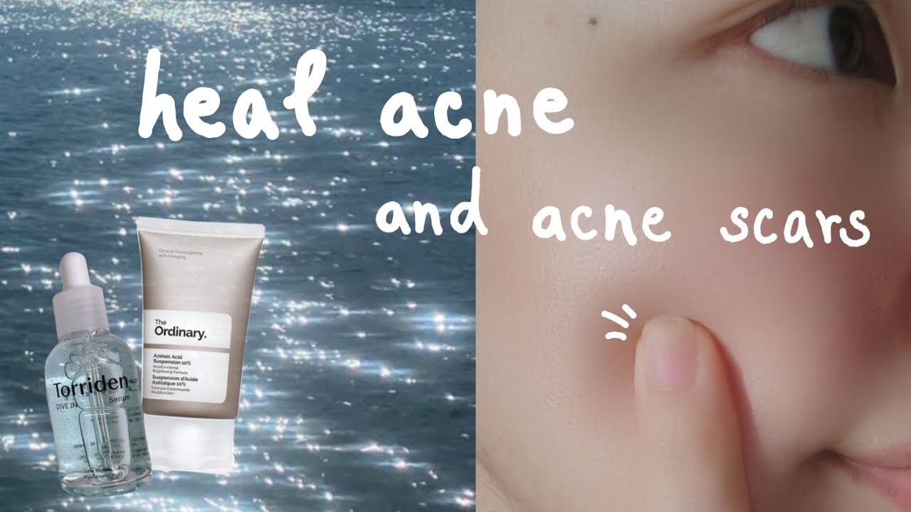 get rid of redness and acne scars, ♡simple formula♡