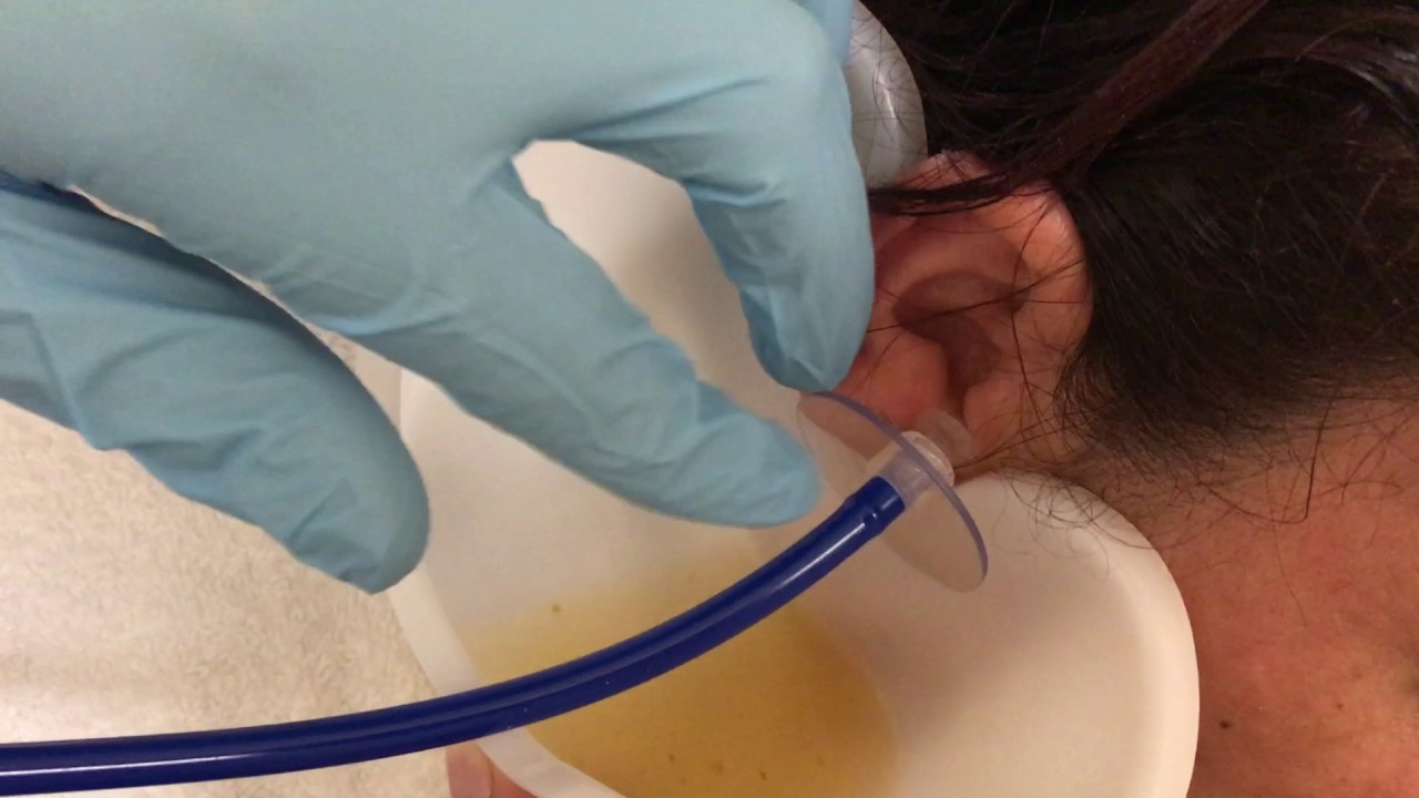 ear wax irrigation