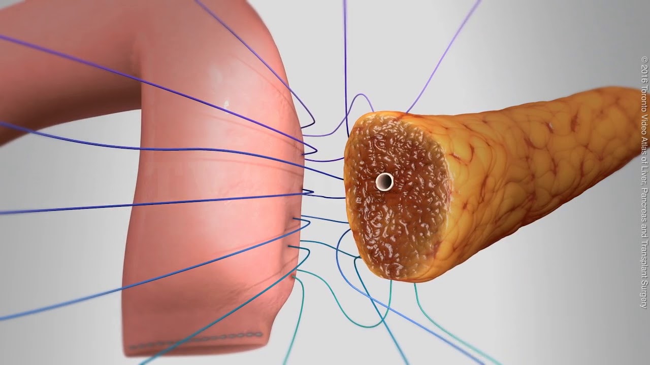Two-layer bowel anastomosis-style pancreaticojejunostomy (