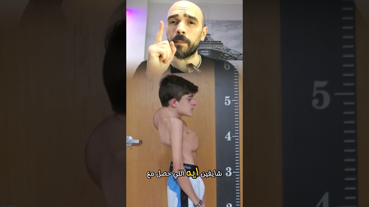 تعرض لإنحناء شديد في العمود الفقري .. وما فعله الأطباء أذهل الجميع !!