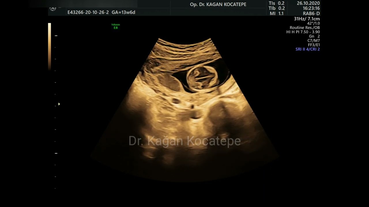 13+6 weeks pregnancy. Ultrasound video of a baby boy.