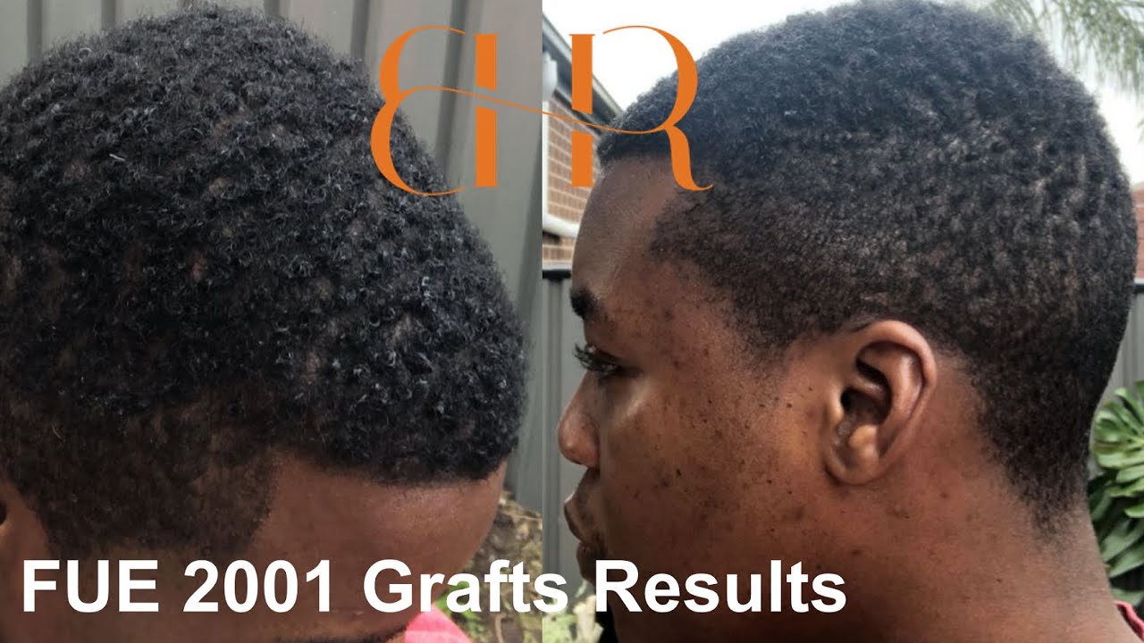 FUE Hair Transplant Result - 2001 Grafts (0 days to 9 Months Post Operation) Afro Hair | BHR Clinic