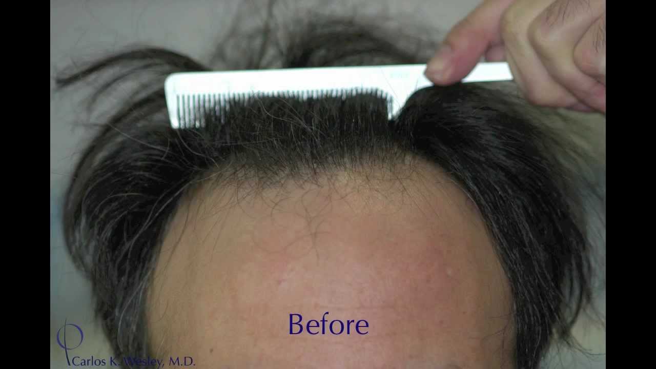 Advancing a High-Definition Hairline: 4480 grafts