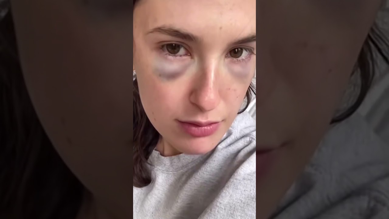 Blepharoplasty - 1 Month After