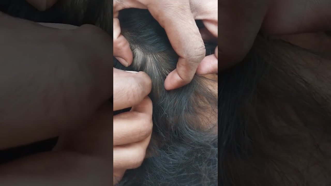 Nitpicking ASMR video 298   #nitpicking #asmr #kuto #piolhos #petantumo #licepicking #catandopiolho