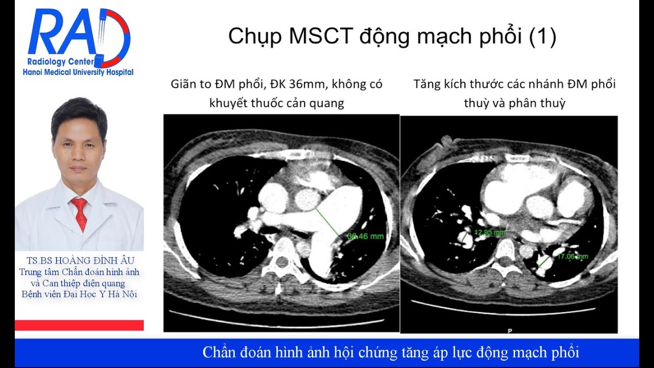 Chẩn đoán hình ảnh hội chứng tăng áp lực động mạch phổi