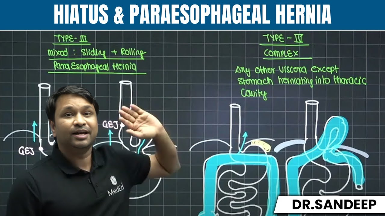 Hiatus & Paraesophageal Hernia | Surgery Lectures | MBBS 4th Year/ NEET PG | BLS Series | Dr Sandeep
