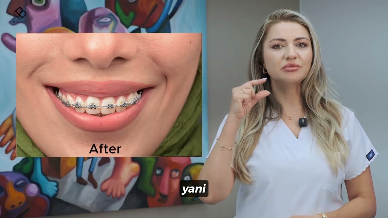 Gummy smile ( Diş Eti Gülümsemesi) Nedir? Hangi tedavi size uygun?