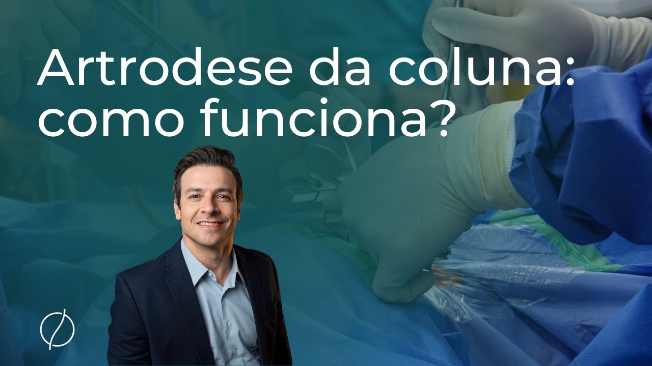 Artrodese da coluna: como funciona?