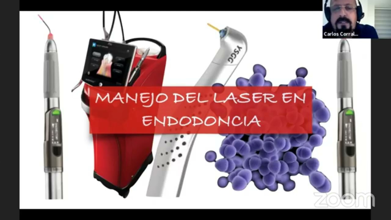 Manejo de Laser para la Desinfección de Conductos Radiculares