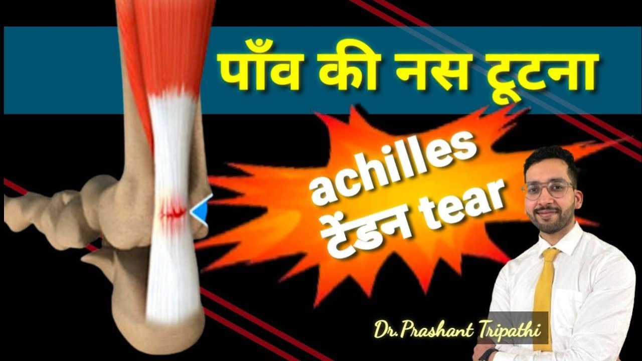Tendoachilles Tear Recovery Journey: Dr. Prashant Tripathi Se Jane Sab Kuch”