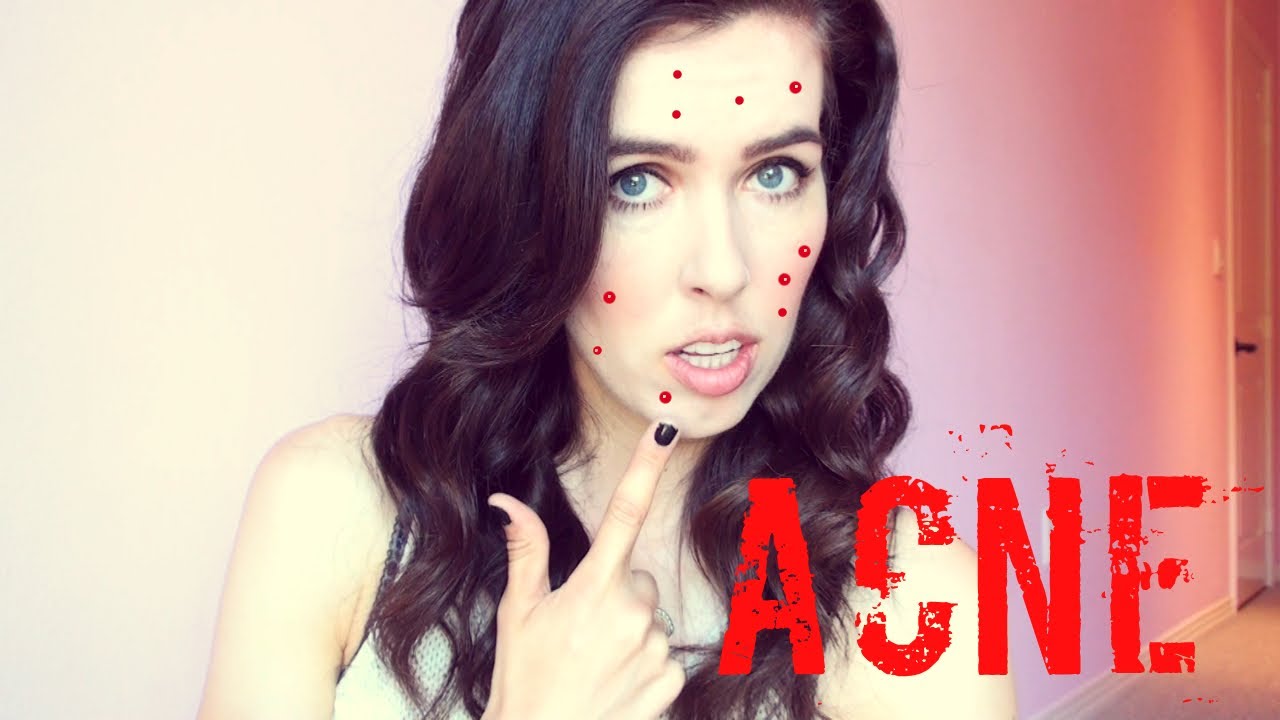 ♥ How To ♥ Cover Up Acne!