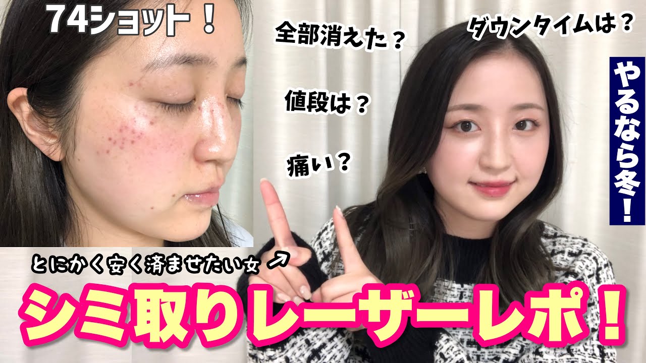【美容医療】シミ取りレーザーの1週間の経過とレポ！費用や注意点など全部紹介！