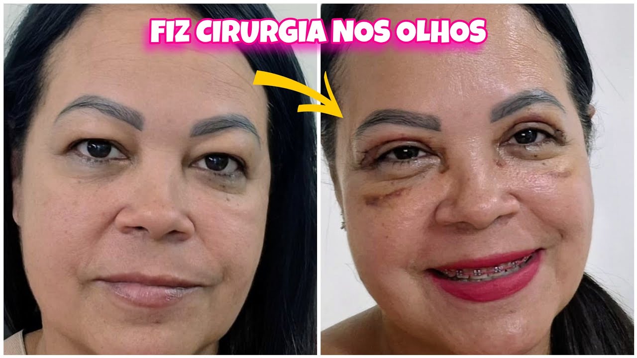 Fiz Cirurgia nos olhos  (BLEFAROPLÁSTIA) Meu  antes e Depois Real.