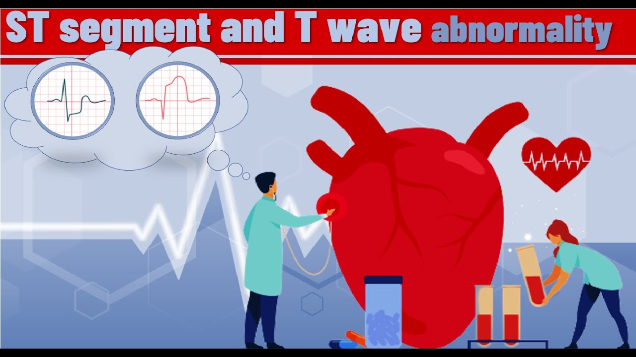 ST segment and T wave abnormality | ST T changes | classification and ECG examples | ECG basics