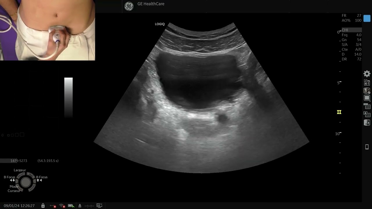 Apprenez à explorer les voies urinaires par échographie en médecine générale !