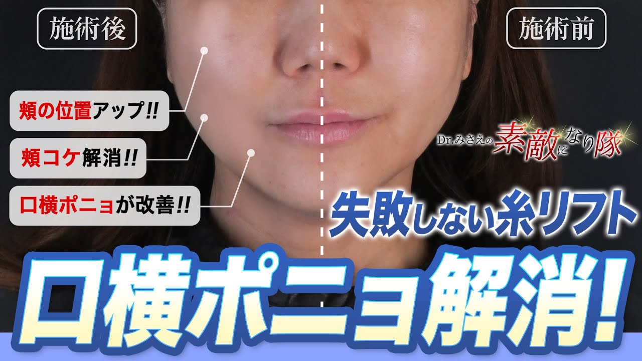 【糸リフト】口横のたるみと頬のコケを同時に解消する最新リフトアップ術を実演！