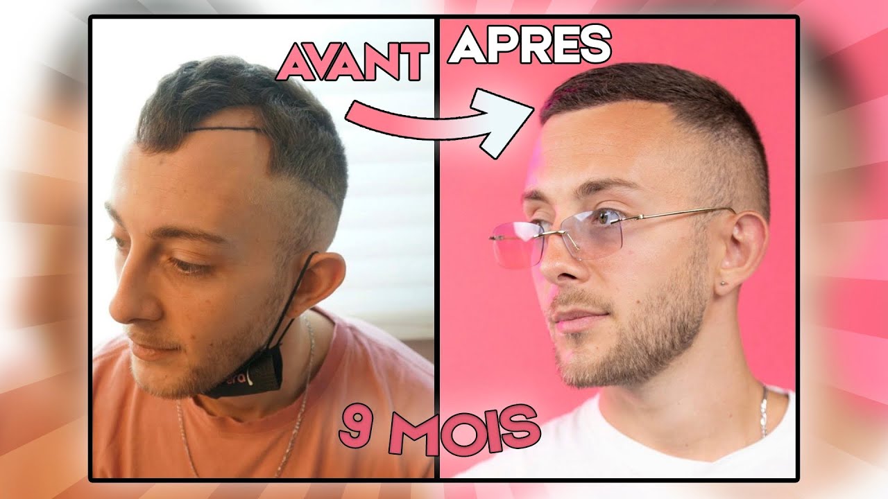 LE RÉSULTAT DE MA GREFFE DE CHEVEUX ! ( incroyable )