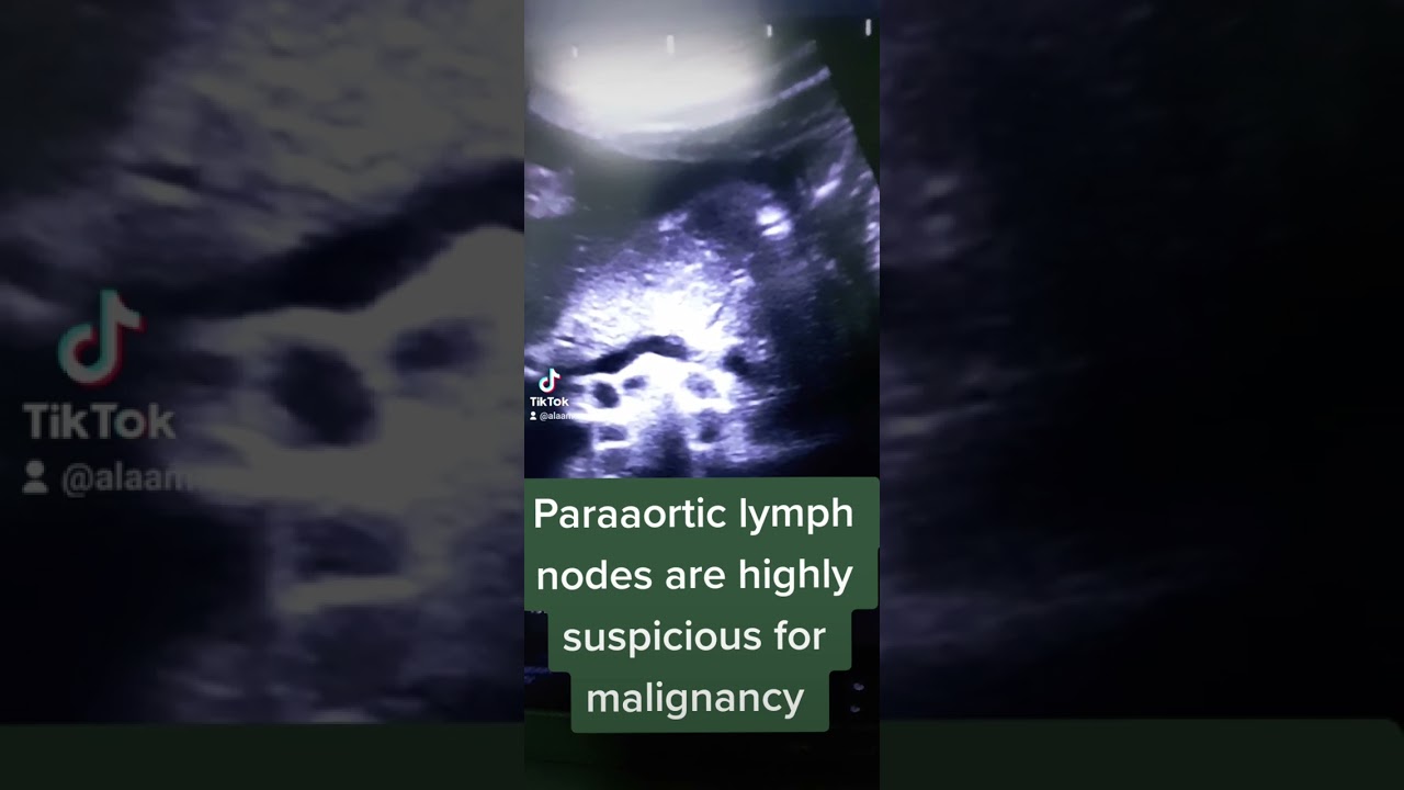 paraaortic lymph nodes make sense for traditional abdominal scanning  @sonographer/Alaa Moaz