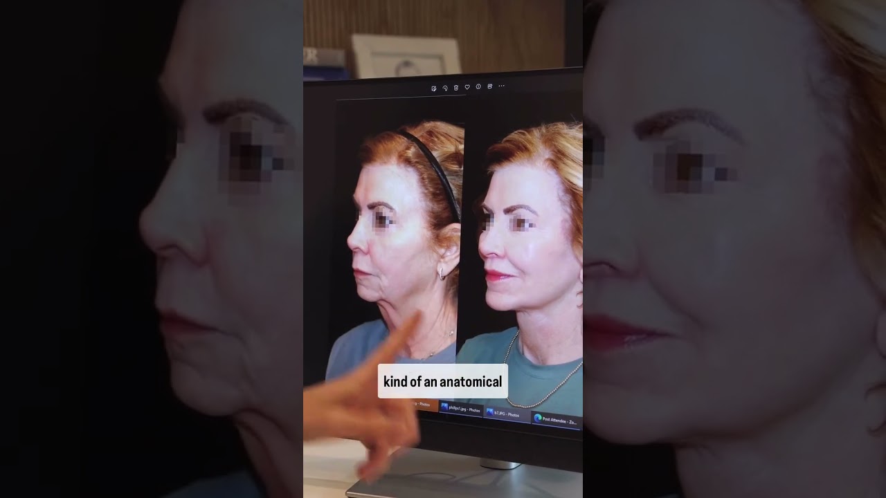 Does a facelift get rid of your smile lines?? #facelift #smilelines