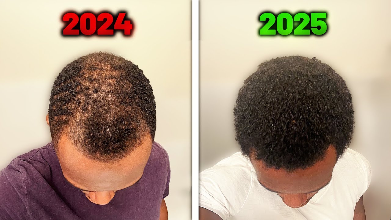 Your Hair Loss Is NOT Inevitable Here's How To Stop It