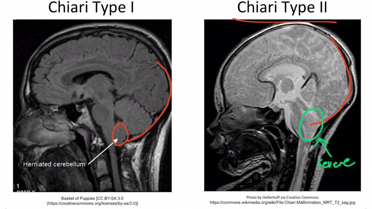 Embryology Neurology Section 2  Posterior Fossa Malformation
