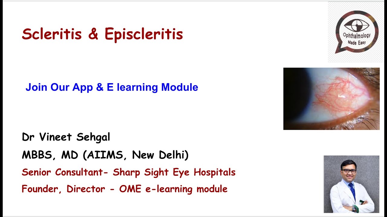 Scleritis & Episcleritis II Causes- Red Eye