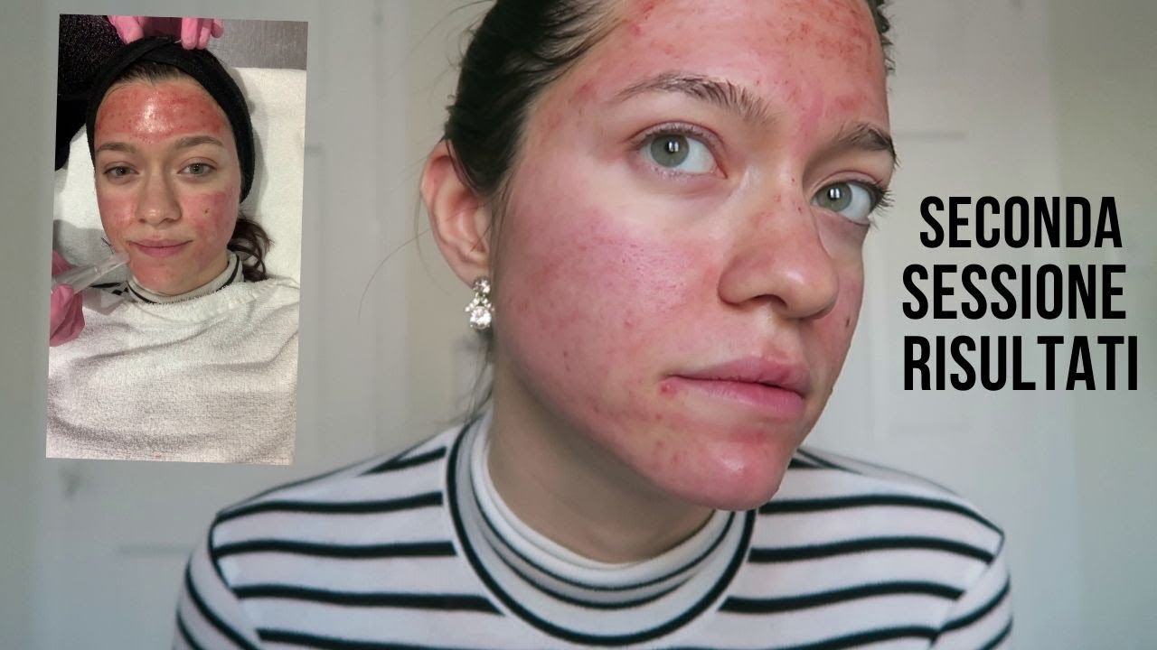 Cicatrici Acne Seconda Sessione Microneedling Update
