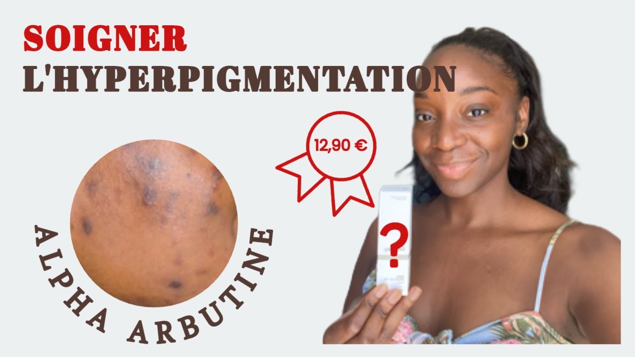 SOIN DU VISAGE - Soigner l'hyperpigmentation/tâches brunes : The ordinary