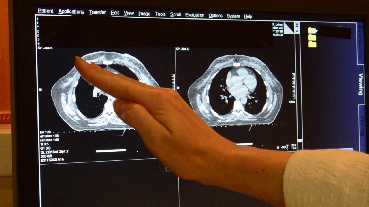 DIBH Radiation Therapy