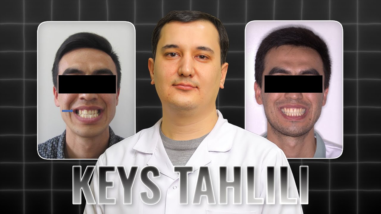 Katta Pastki Jag‘ni To‘g‘irlash | Keys Tahlili | Jasur Qodirov
