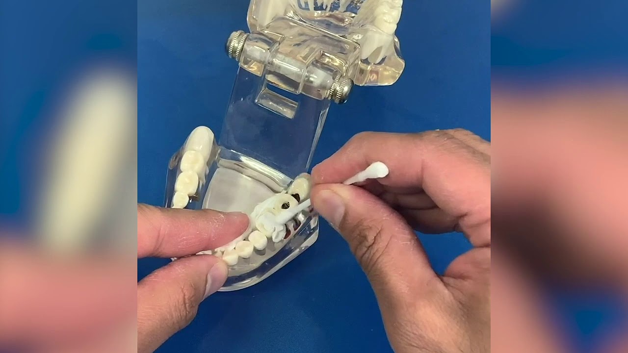 How to use temporary dental filling material