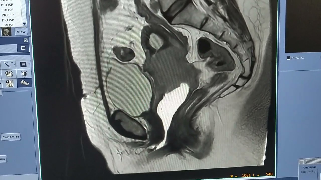 A importância do gel vaginal na Ressonância Magnética da Pelve.