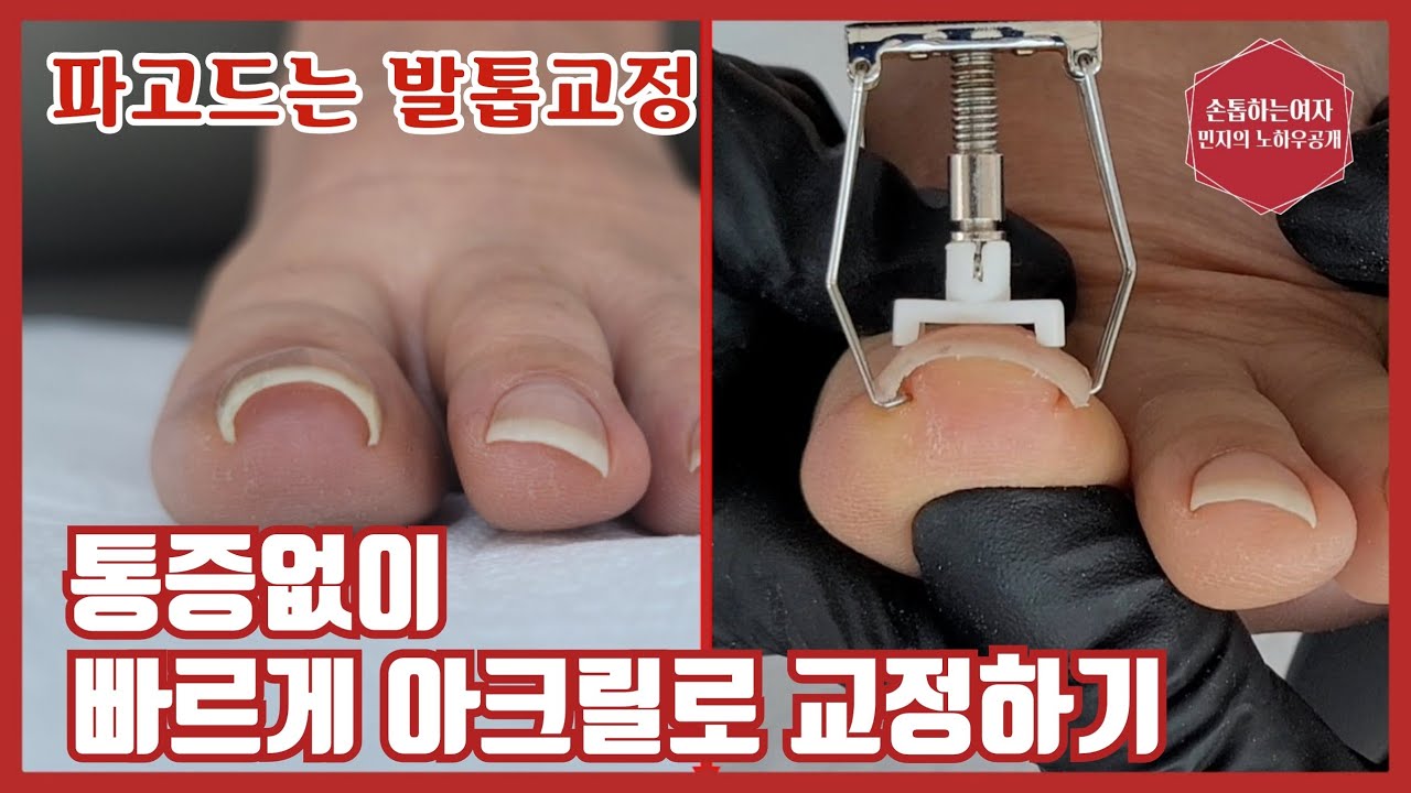 제137화[파고드는발톱교정]아크릴로간단하게!! 시술직후통증제로!!